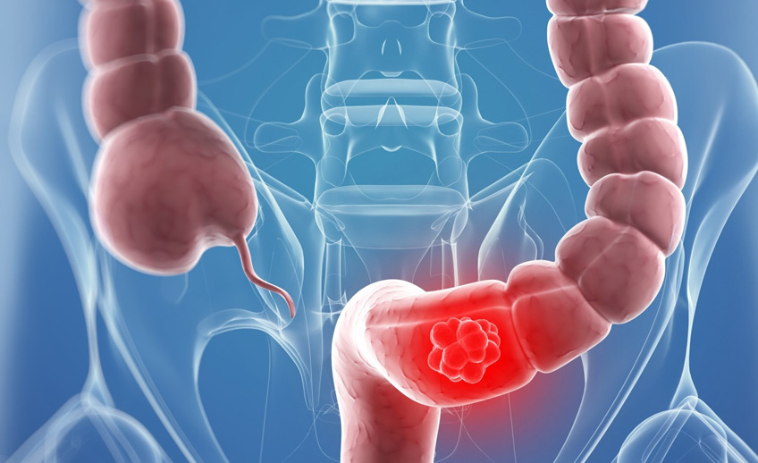 Colon Cancer Screening Orlando Gastroenterology Consultants